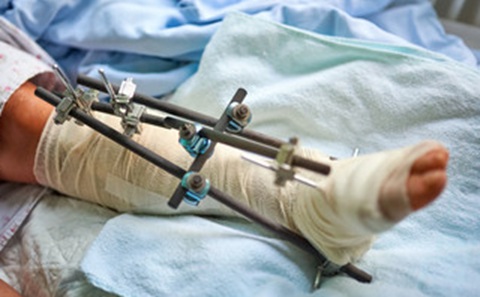 Limb Fractures